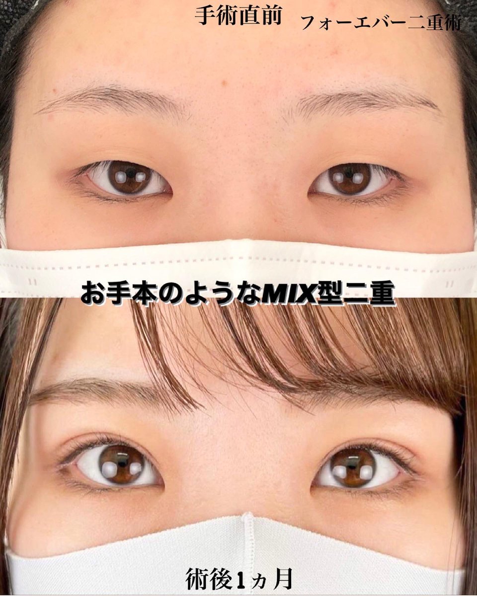 ymmtakys's tweet photo. mix型二重、人気です。 https://t.co/qTx6PEQHPi