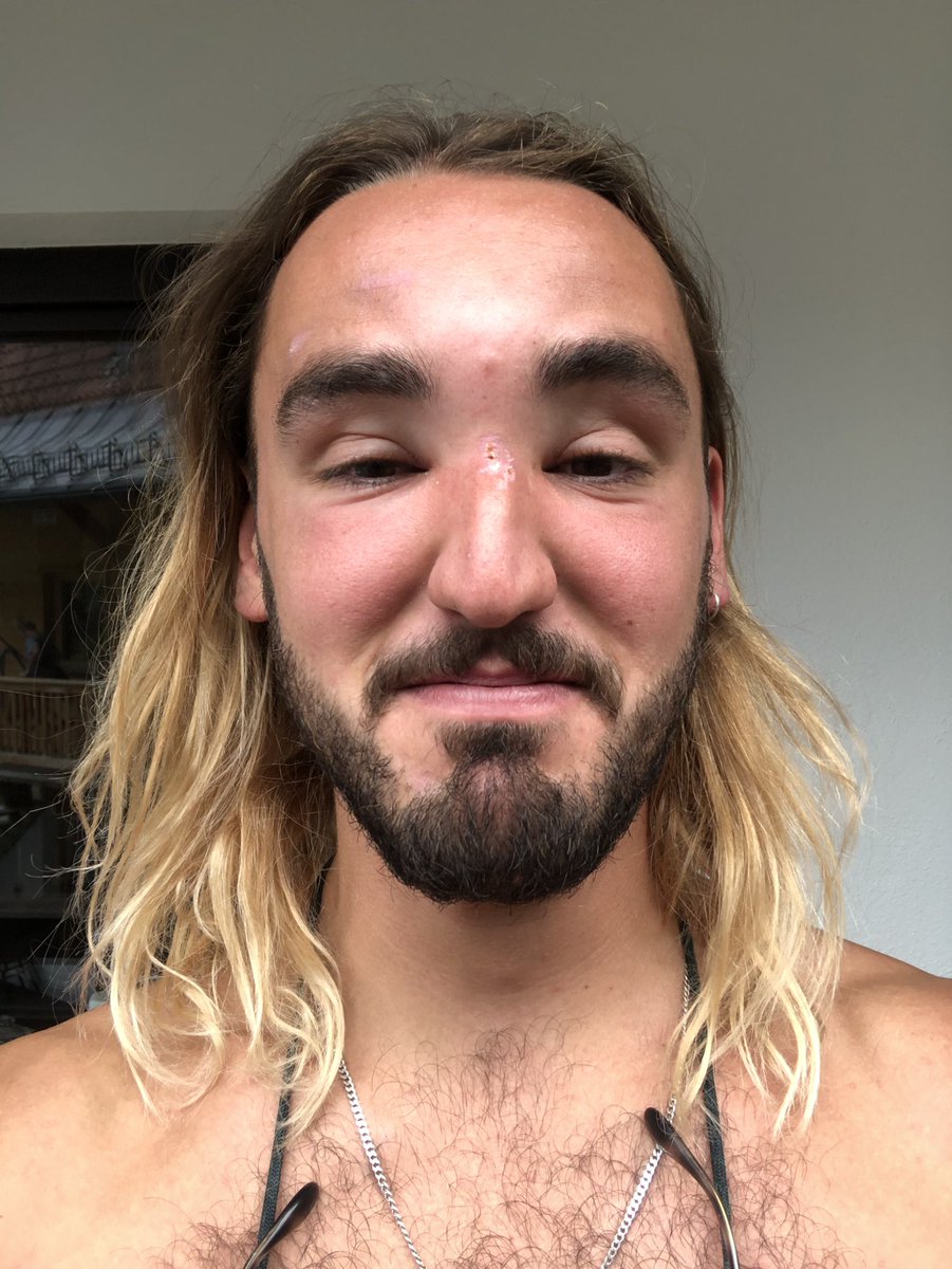 mattyzmith's tweet photo. Turns out im allergic to bee stings https://t.co/H0hCyD0Dau
