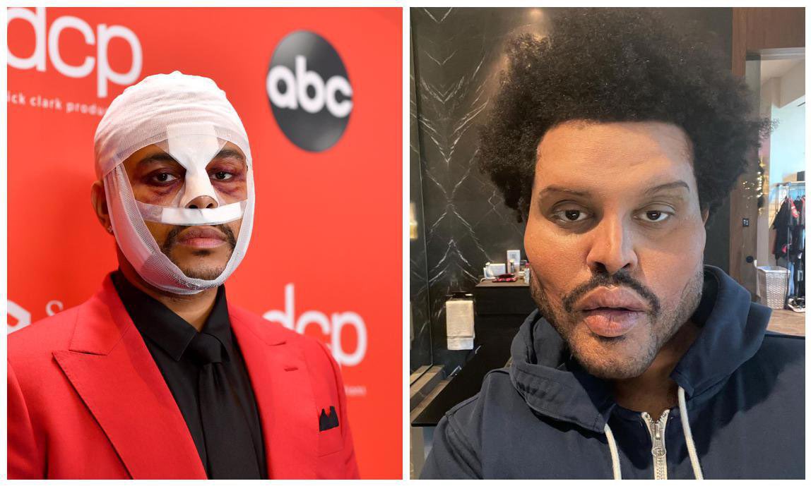 alexb_official1's tweet image. Before Abel Tesfaye got his plastic surgery, my girlfriend thought he looked perfectly fine. She still thinks he is attractive but she wants him to know that he shouldn’t change for anybody. Just to be yourself. We love you Abel!❤️ @theweeknd #youlookfine #beyourself