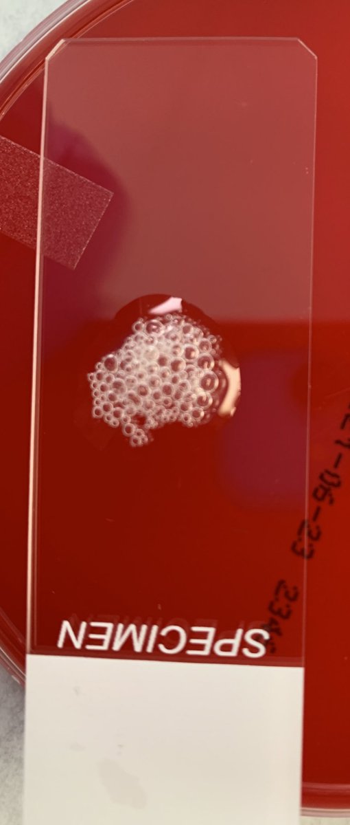 odie0222's tweet photo. Neisseria gonorrhoeae: STD, disseminate to joints, and possible sepsis. Drug resistance emerging. Oxidase + catalase + Routine AST not performed
#PathTweetAward #PathTwitter #IdBoardReview #pathboard #medlabchat #lab4life #ASCPSoMeTeam #micromed https://t.co/ndh0hbm6d7
