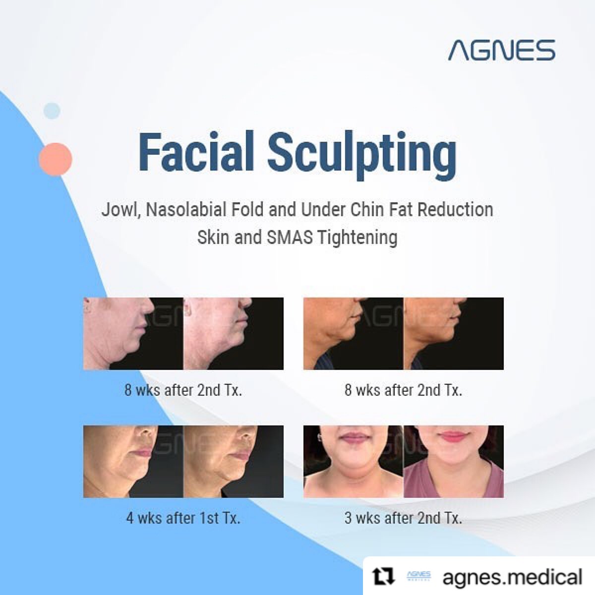 mariatradingco's tweet photo. #Repost @agnes.medical
AGNES FACIAL SCULPTING 😃
Jowl, Nasolabial Fold and Under Chin Fat Reduction
Skin and SMAS Tightening
#MariaTrading
#agnes #agnesmedical #agnesrf #radiofrequency #rfneedle #insulatedneedle
#microneedling #microneedling #microneedlingrf #doublechin https://t.co/dexOwjfZs1