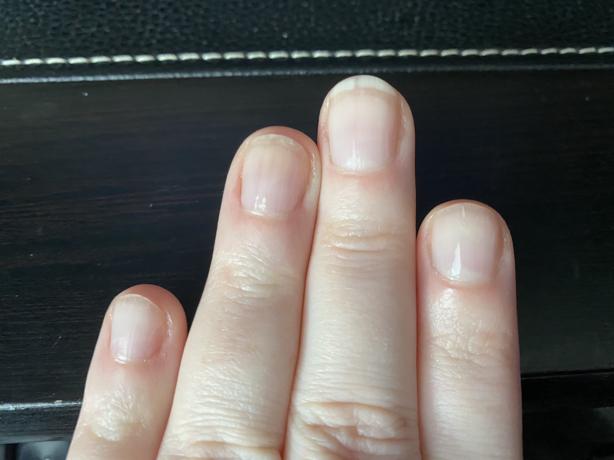 Brown Line on Nails: Vitamin Deficiencies and Other Causes