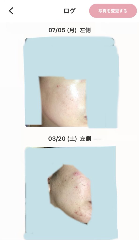 アダパレンゲル