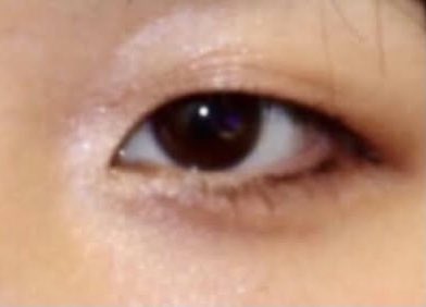 kme_kys's tweet photo. 埋没経過
今月で12ヶ月
埋没前はかなり薄い奥二重で上の瞼がまつ毛に被さってまつ毛下向きに
これでもマスカラアイラインがっつり、全然盛れてない😂
わざと薄目にすると奥二重ライン見えるけど普通にしてたら見えない、良かった✨
#二重埋没
#聖心美容クリニック
#奥二重 https://t.co/ui1mt9EIcw