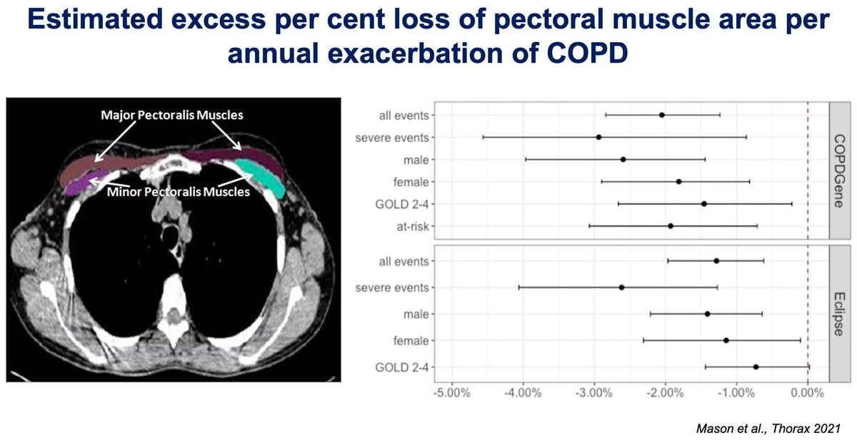 Longitudinal evidence for loss of muscle mass in exacerbating patients with COPD @ThoraxBMJ