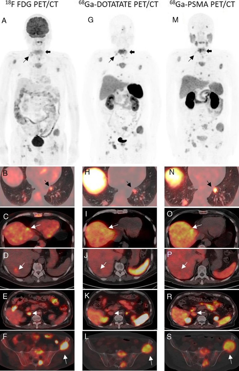 Current Issue: Metastatic Poorly Differentiated Thyroid Cancer With Heterogeneous Distribution of 18F-FDG, 68Ga-DOTATATE, and 68Ga-PSMA on PET/CT dlvr.it/S357cv