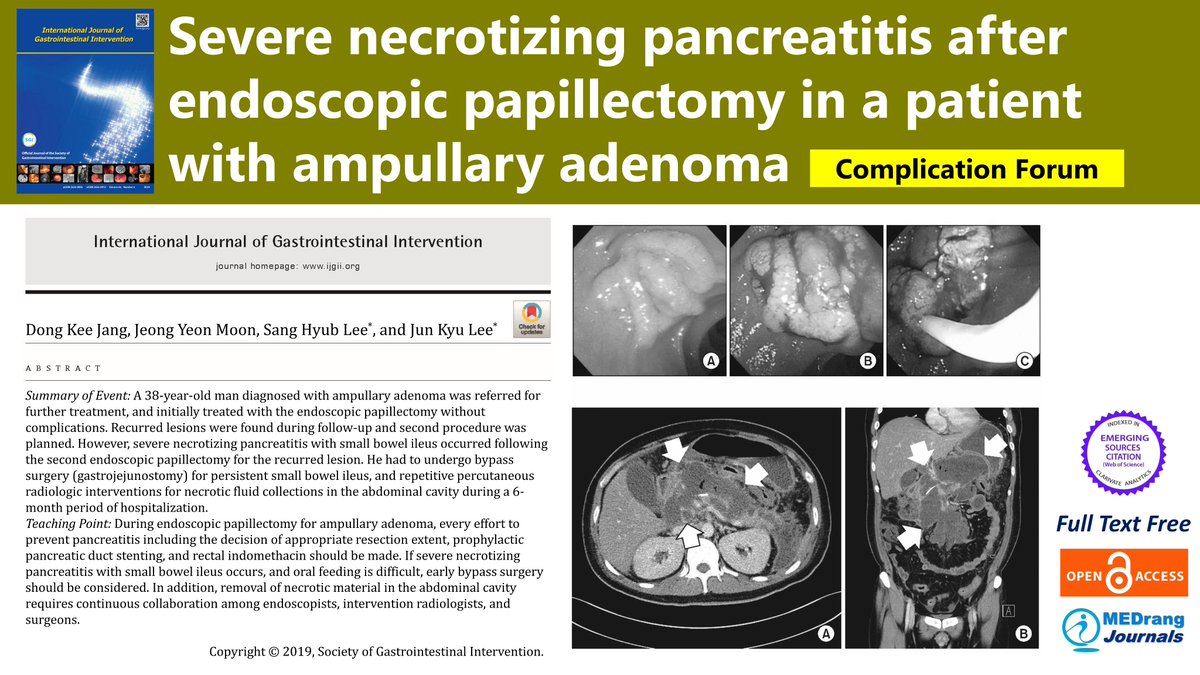 IJGII_SGI's tweet image. Severe necrotizing pancreatitis after endoscopic papillectomy in a patient with ampullary adenoma

bit.ly/3hwRias
Int J Gastrointest Interv 2019; 8(2): 100-103
#Endoscopic_mucosal_resection #Pancreatitis #acute_necrotizing #Radiology #interventional #Surgery