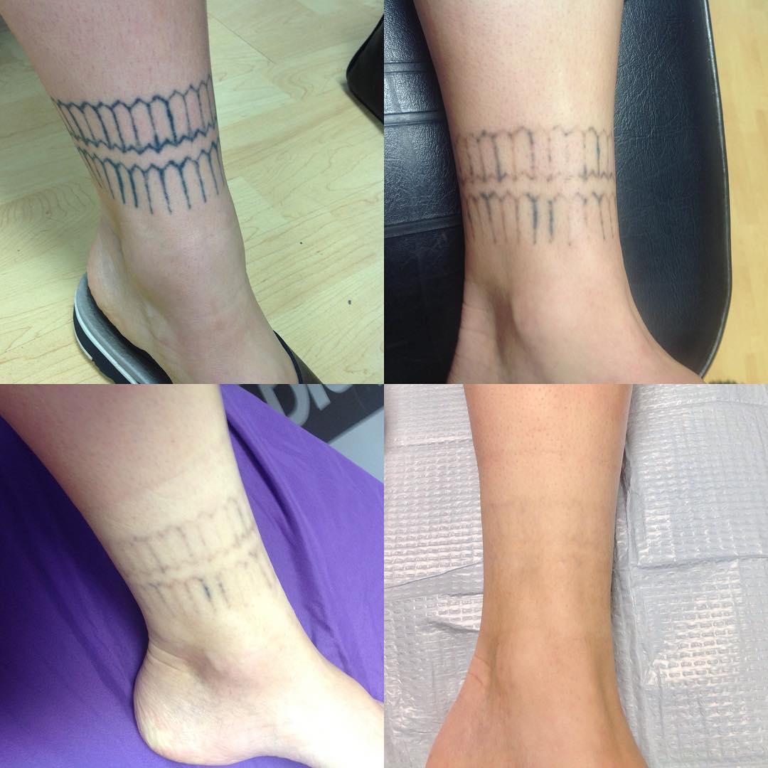 Tattoo Removal in Birmingham  Check Prices  Reviews