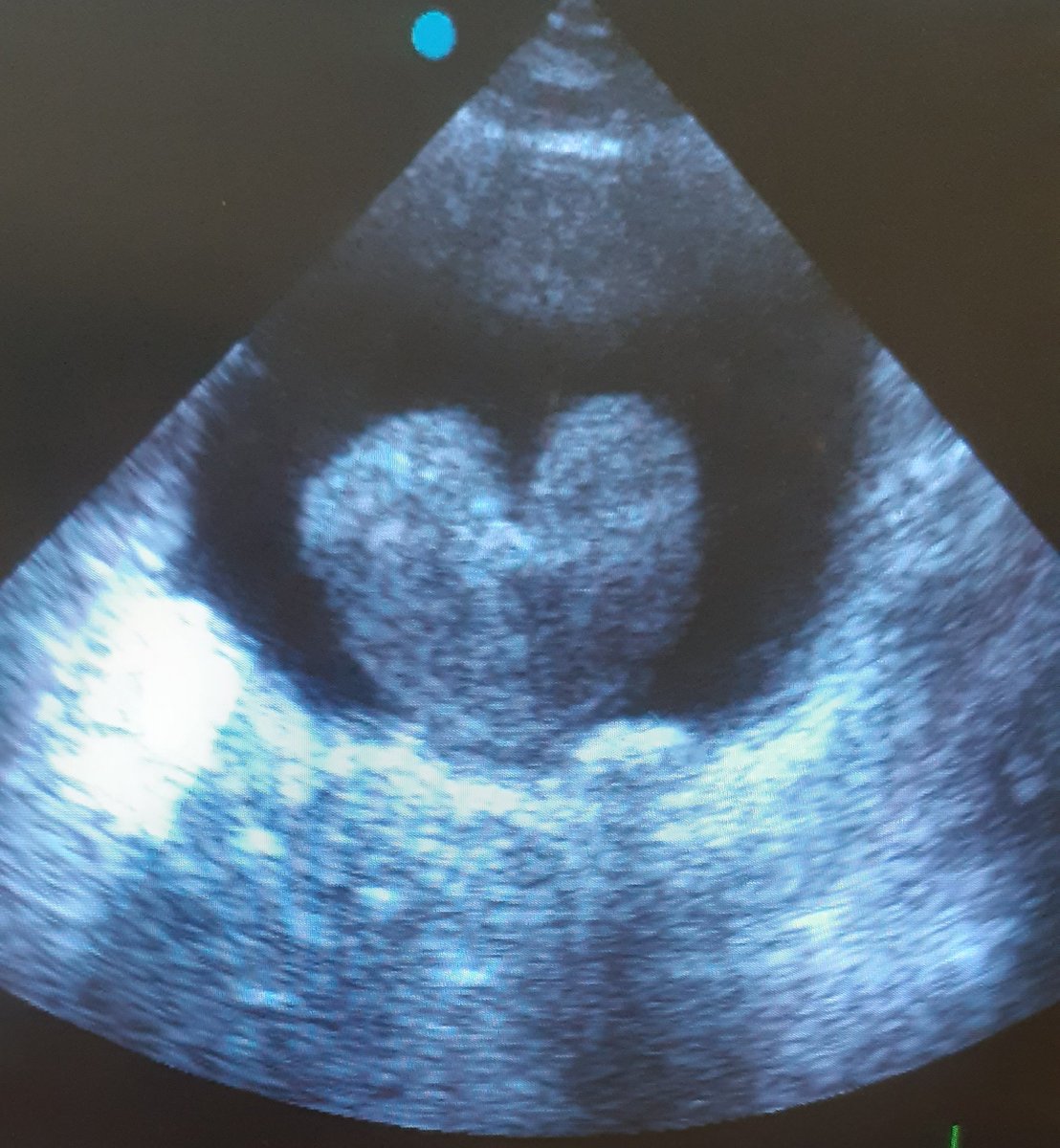 benatta2010's tweet photo. Median prostatic obstructive lobe 
Can't resist 
I Share it https://t.co/5QpaNn1WMk