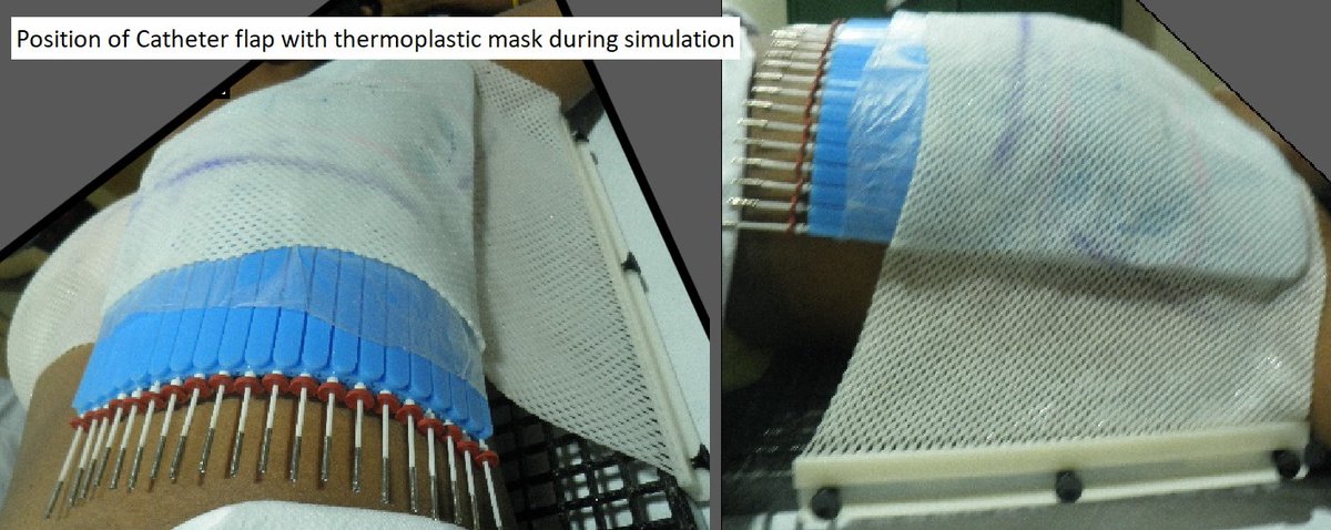 AdamChiche's tweet photo. #MedPhys contribution in #flap #brachytherapy for #Chestwall #postmastectomy scar #boost - dosimetric advantages in detail:
https://t.co/vw4kzxeoQY
#ThisIsBrachytherapy #jocb #IBS #GBBS #Acuros https://t.co/8Esihrn3A7