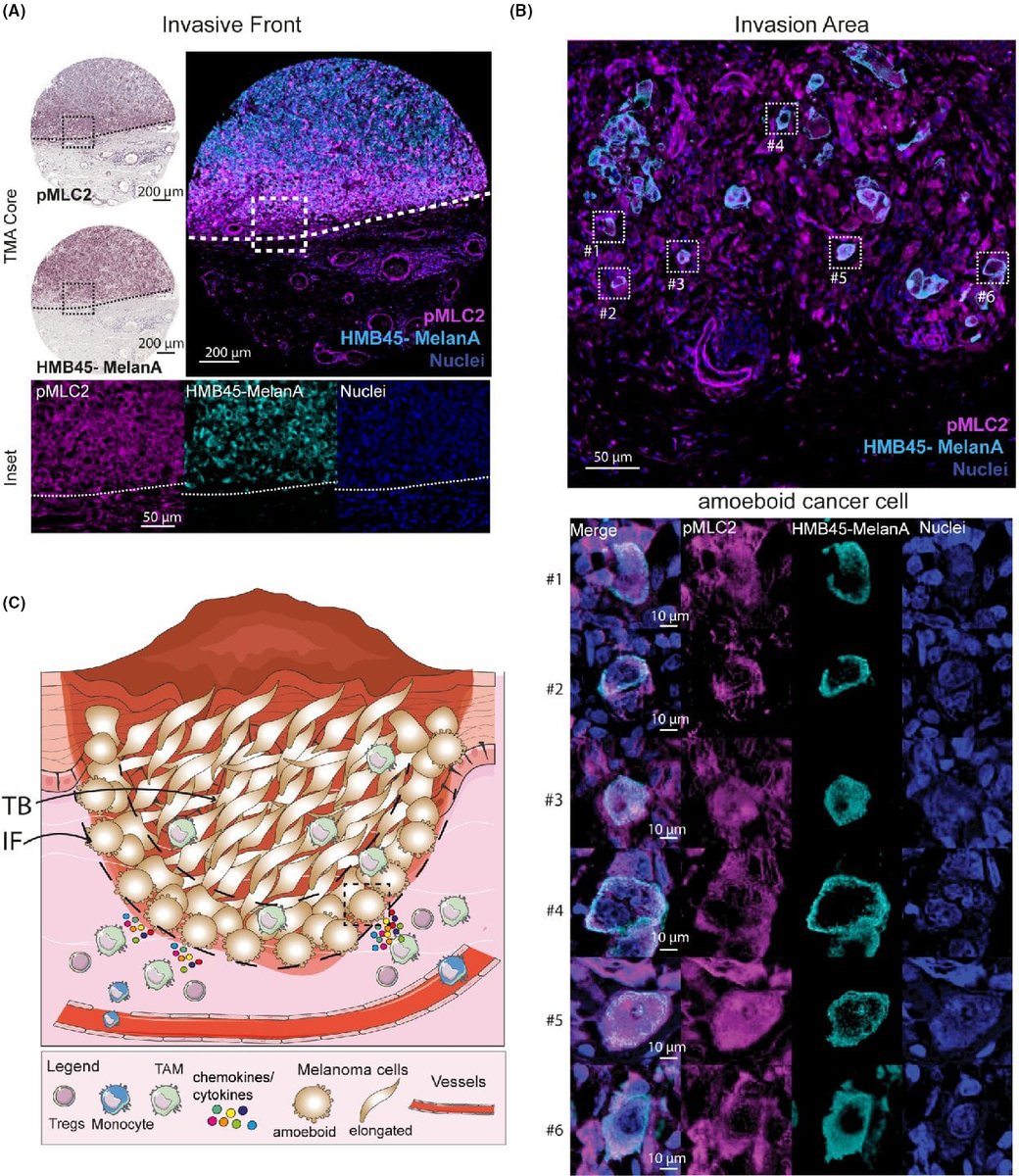 Vicky Sanz-Moreno (@vickysanzmoreno) on Twitter photo Take a look at these aggressive cancer cells within patient tissues, while they invade. We discuss key features of this behaviour. Great work <a href="/Omaiques/">Oscar Maiques</a> <a href="/QMBCI/">Barts Cancer Institute (Queen Mary)</a> Take a look at these aggressive cancer cells within patient tissues, while they invade. We discuss key features of this behaviour. Great work <a href="/Omaiques/">Oscar Maiques</a> <a href="/QMBCI/">Barts Cancer Institute (Queen Mary)</a>