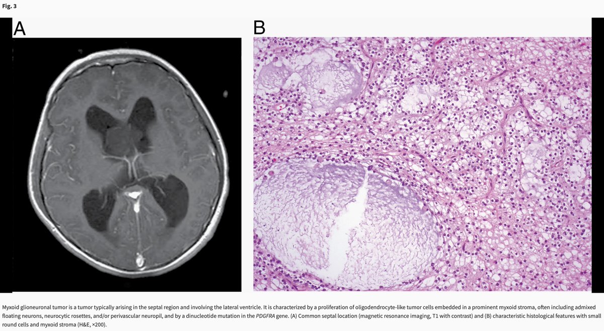 The_ASPNR's tweet photo. The 2021 WHO Classification of Tumors of the Central Nervous System: a summary

https://t.co/iJ8thK6tCs

"this summary provides an overview to facilitate more in-depth exploration of the entire fifth edition of the WHO Classification of Tumors of the Central Nervous System." https://t.co/a14acB4Rpq