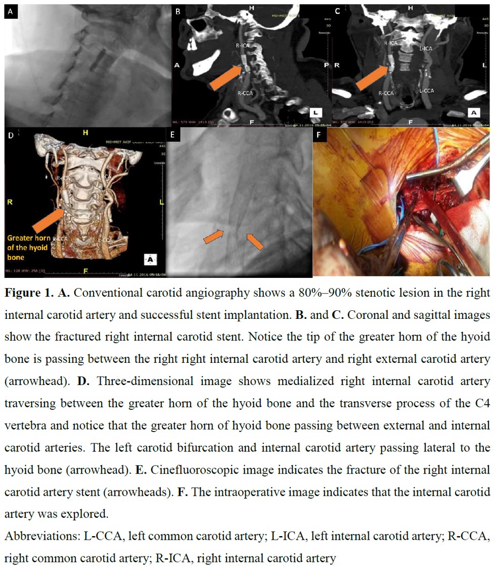 Editors’ Insights: Internal #carotid #artery #stent #fracture likely caused by hyoid bone compression.

bit.ly/3hhyP2v #KardiologiaPolska #PolishHeartJournal

#cardiotwitter #HeartNews @sertunsuzzz @drunal_aydin  @cagdastpl @imaeh_saglik