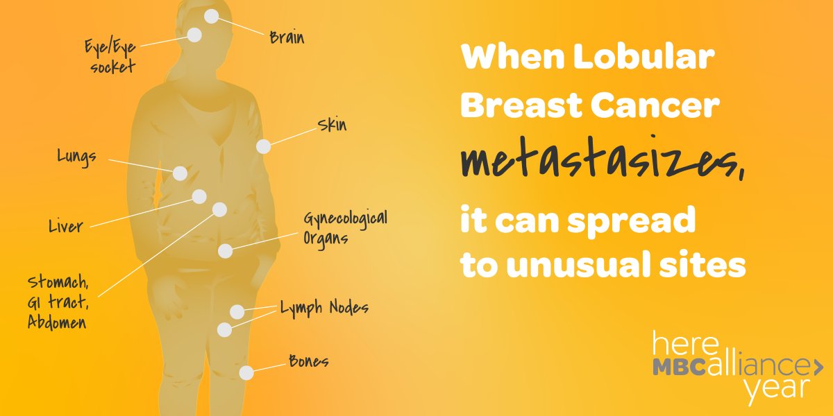 mbcalliance's tweet image. This month for Here All Year, we’re focusing on Metastatic #Lobular Breast Cancer. Learn more about the unique metastatic sites in Invasive Lobular Carcinoma (ILC). Visit our site to read more:  mbca.me/30oSxR0 #bcsm #HereAllYear #