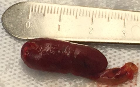 American Association of Endocrine Surgeons (@theaaes) on Twitter photo Most parathyroid glands are the size of a grain of rice. Enlarged parathyroid glands can be 5 times that size! #CheckYourCalcium #JAM2021 <a href="/TheAACE/">AACE</a> <a href="/ParaTroupers1/">ParaTroupers</a> <a href="/TheEndoSociety/">Endocrine Society</a> Most parathyroid glands are the size of a grain of rice. Enlarged parathyroid glands can be 5 times that size! #CheckYourCalcium #JAM2021 <a href="/TheAACE/">AACE</a> <a href="/ParaTroupers1/">ParaTroupers</a> <a href="/TheEndoSociety/">Endocrine Society</a>