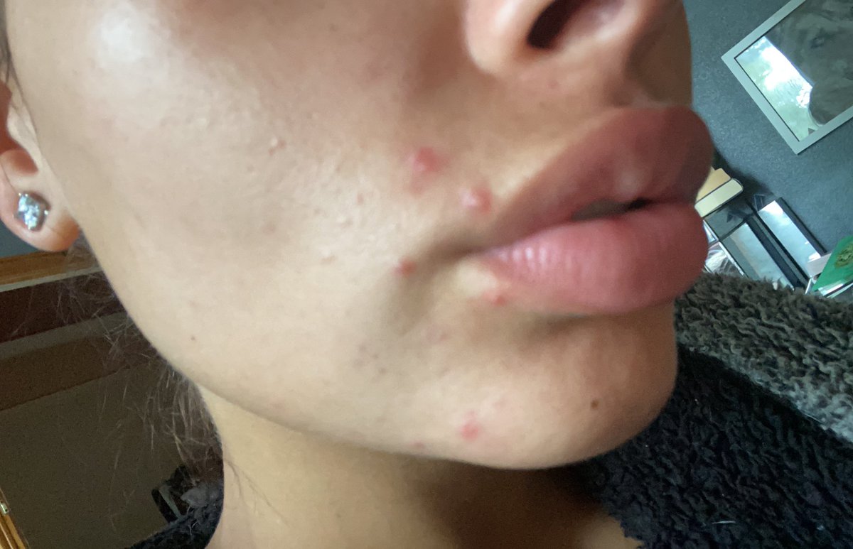 Anyone else struggling with maskne or just me? Friendly reminder though that imperfections are okay and are what make us human - Clo x