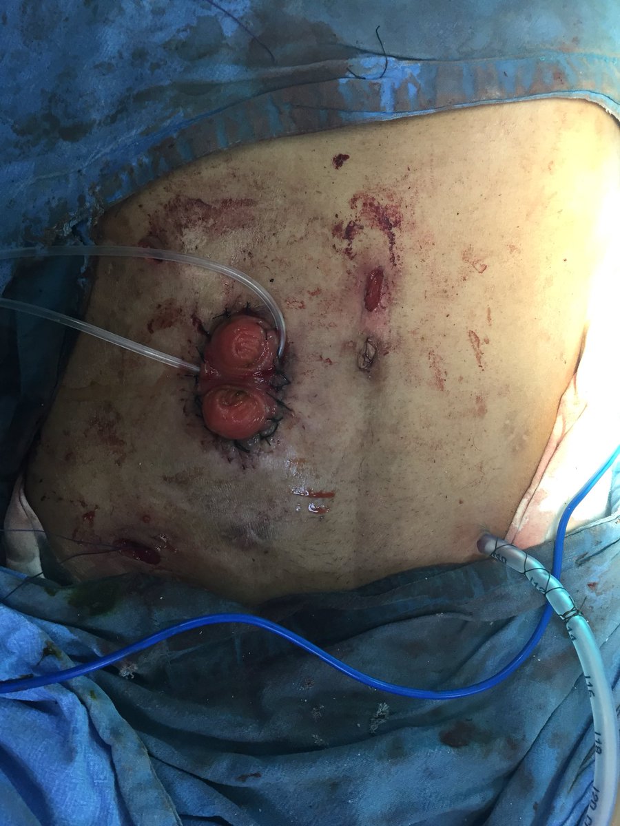 28/M, severe steroid/biological refractory #UlcerativeColitis. Second stage completion protectomy with #IPAA after 6 months of lap TAC. Stoma closure done after 2 months. Good pouch function currently. Stool frequency 4-5 times. #IBDSurgery #ilealpouch #laparoscopicsurgery