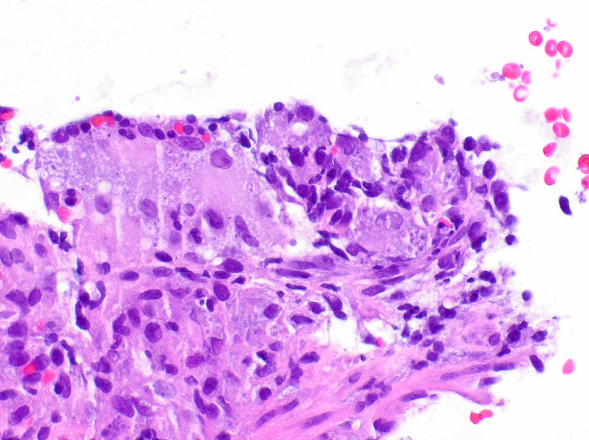 LizMontgomeryMD's tweet photo. A striking case of histoplasmosis.  It really is nasty about mimicking Crohn's disease. https://t.co/lg08Os6xVH