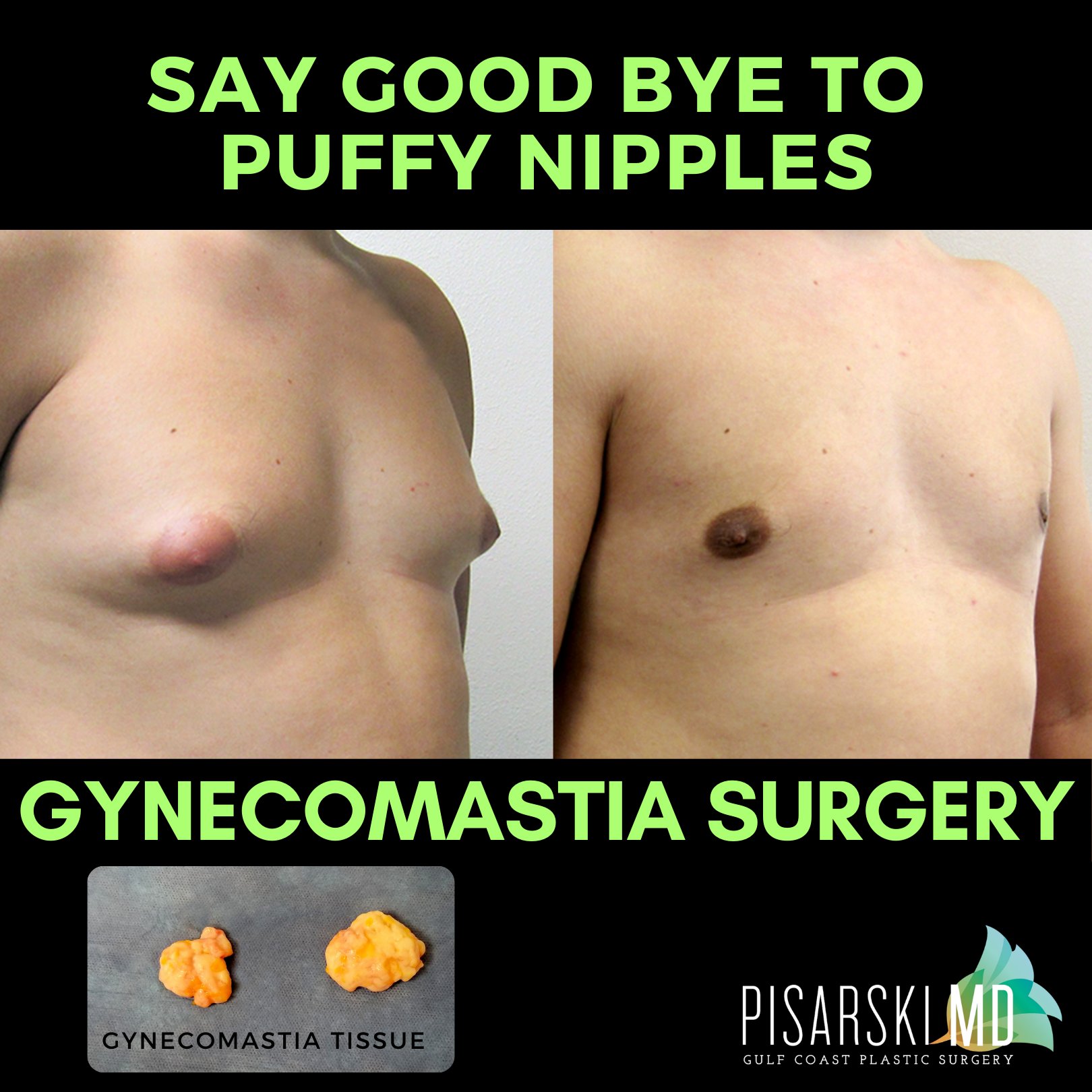 Gregory P. Pisarski on X: You dont have to hide your puffy nipples with  loose clothing any longer. (Get Summer Ready) ➡️Many men suffer from  gynecomastia - a condition where men have