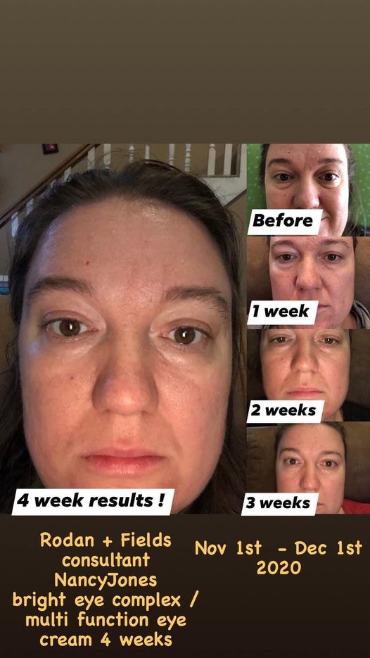 monikalovesjay's tweet image. This is our newly reformulated magnificently brilliant Multi Function  Eye Cream in action for you!! 
😍✨Best✨Eye✨Cream✨Ever✨😍 

#rodanandfields #multifunctioneyecream #liftandfirm #lovetheskinyourein #glowwithmonika