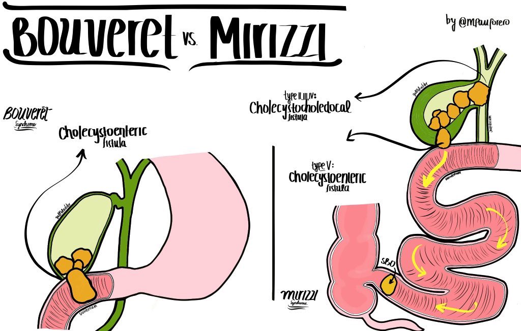 María Paula Forero, MD (@mpauforero) on Twitter photo 🔶Bouveret syndrome vs. Mirizzi syndrome🔶
#MedEd #MedTwitter #SoMe4Surgery @Cirbosque <a href="/MISIRG1/">MISIRG</a> <a href="/SWexner/">Steven D Wexner MD, PhD</a> <a href="/salo75/">Salomone Di Saverio MD PhD FACS FRCS (Eng)</a> <a href="/nara_toyomasu/">豊桝 Sarah なら☀️</a> <a href="/SIGUSABANA/">SIGUS</a> <a href="/fernandoleyvamo/">Fernando Leyva</a> <a href="/PipeCabreraV/">Dr Luis Felipe Cabrera Vargas MD FACS</a> 🔶Bouveret syndrome vs. Mirizzi syndrome🔶
#MedEd #MedTwitter #SoMe4Surgery @Cirbosque <a href="/MISIRG1/">MISIRG</a> <a href="/SWexner/">Steven D Wexner MD, PhD</a> <a href="/salo75/">Salomone Di Saverio MD PhD FACS FRCS (Eng)</a> <a href="/nara_toyomasu/">豊桝 Sarah なら☀️</a> <a href="/SIGUSABANA/">SIGUS</a> <a href="/fernandoleyvamo/">Fernando Leyva</a> <a href="/PipeCabreraV/">Dr Luis Felipe Cabrera Vargas MD FACS</a>