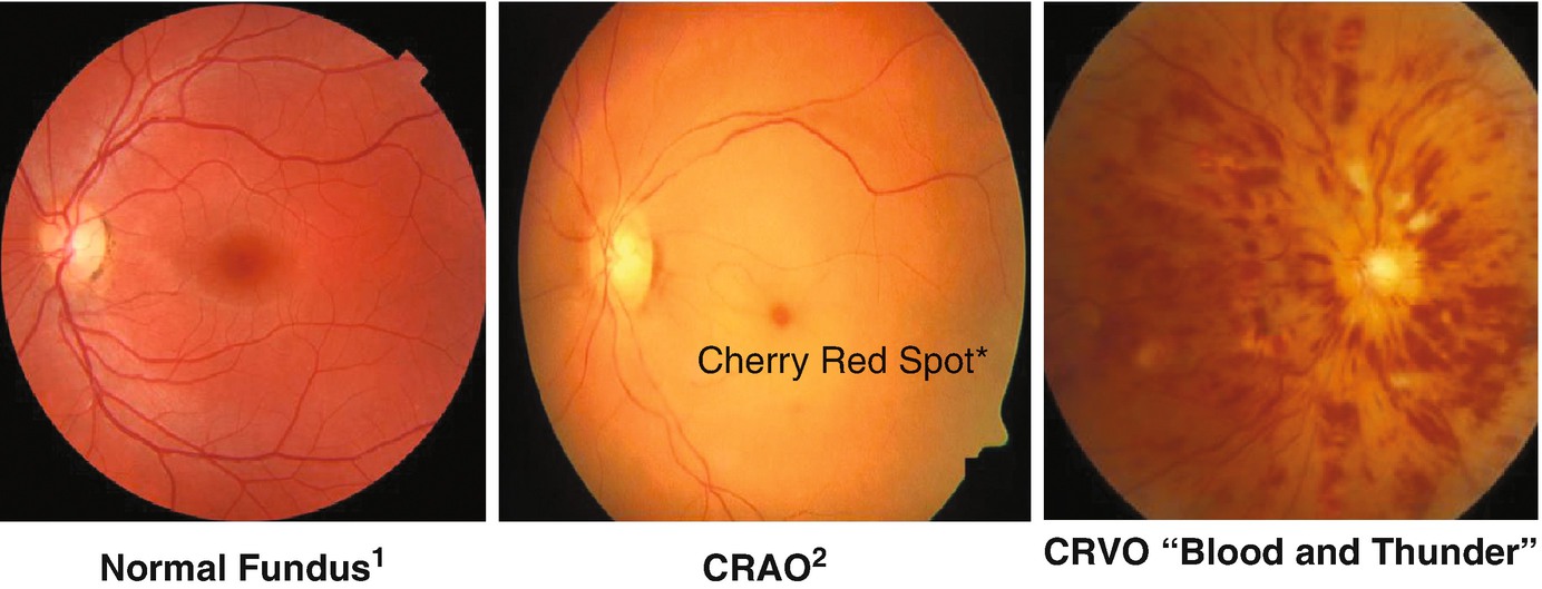 central retinal artery occlusion vs normal