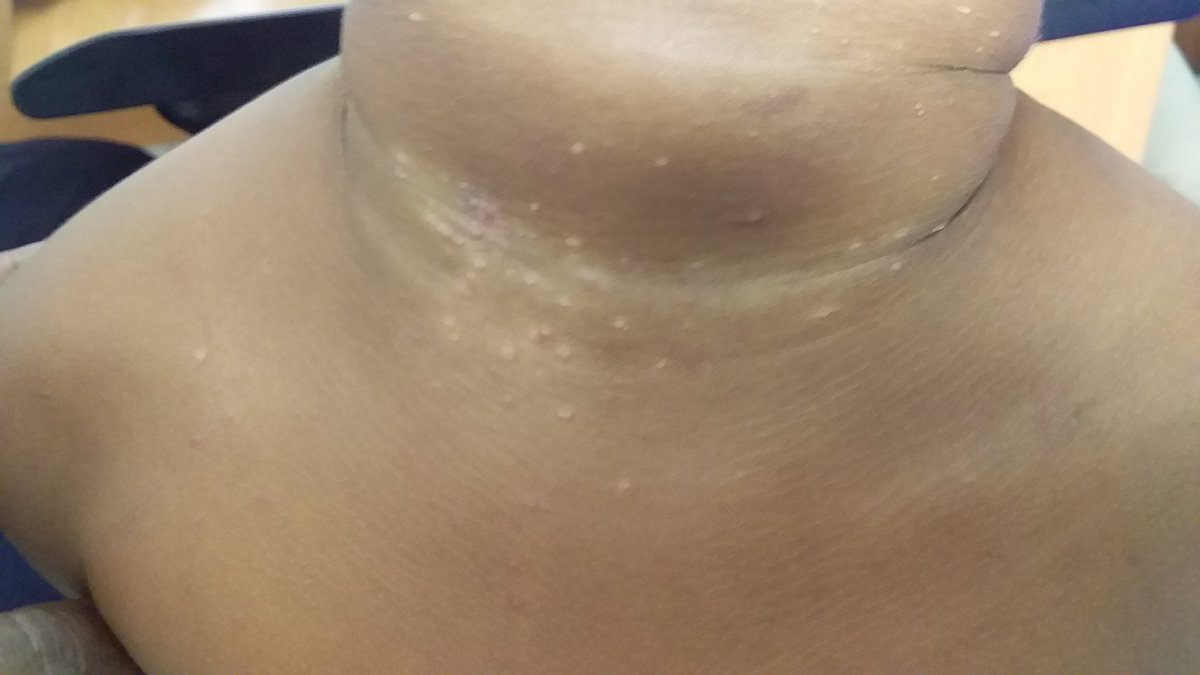 Paed Clinics of Dar, Tanzania:
#Molluscum contagiosum: Caused by poxvirus. Causes chronic localised fleshcoloured dome shaped papules: common childhood disease but can be associated with immunodeficiency. Treatment debatable as often selflimiting.