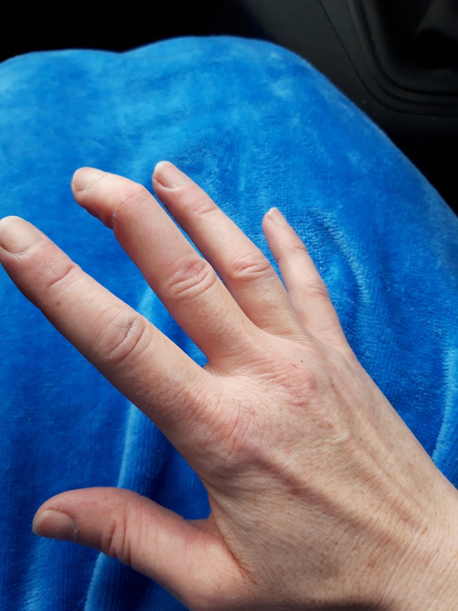 jeebreslin's tweet photo. On the last day of my holidays, and where am I at 11pm !? Letterkenny a&e!!! And its packed! Wonder will i get seen before we have to vacate the rental at 11am tomorrow morn! #malletfinger #damagedtendon #notsore https://t.co/gltmu1wI2H