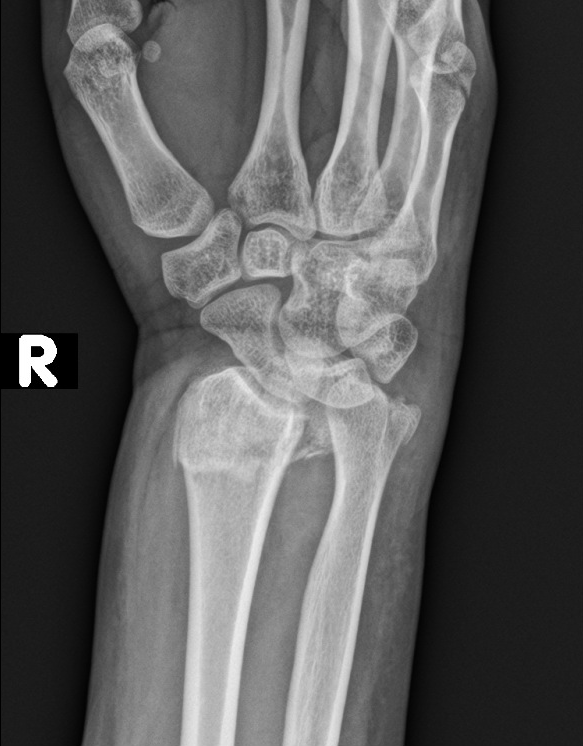RobFarrow_2's tweet photo. Patient presenting after a fall on out stretched hand...Colles fracture &amp; neurovascularly intact...RAPTIR nerve block...pre &amp; post reduction x-rays....RAPTIR for the win!

 https://t.co/ckAlGd1H2l   

https://t.co/WvnUU5plbe https://t.co/hAUoYSHuaw
