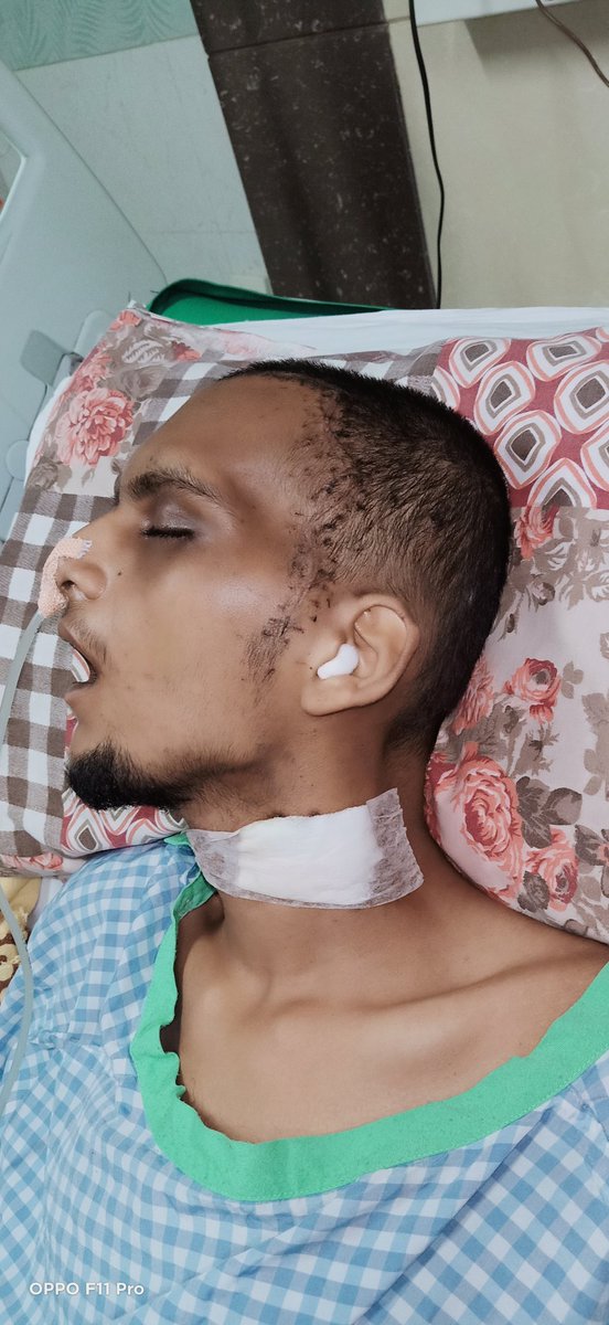 ARIFALI48584775's tweet photo. @imNoorOwaisi Sir Black fungus Ka Brain ka surgery hua Daily 10 injections lagana hai
1 Month 1 injection ka cost 8000/-Rs hai Daily injections ka 80,000/- +Hospital other medicine Charges 50,000/-Total amt 130,000/-hora Save life sir 🙏🙏📱+918686648890 https://t.co/FpSj9uPWif https://t.co/BBv68mCNLV