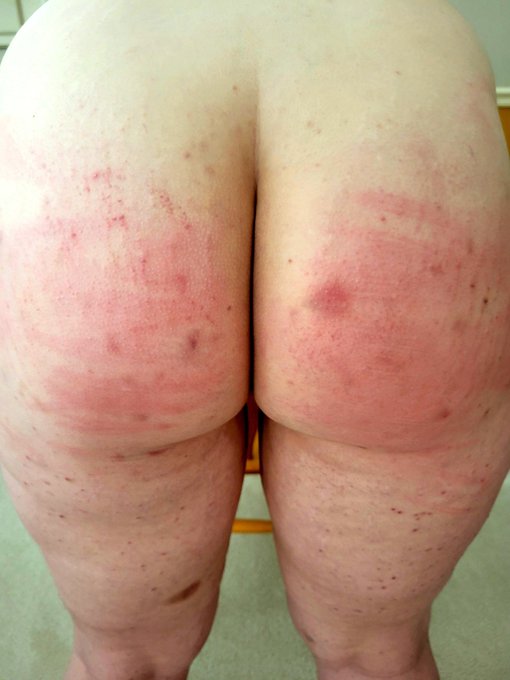 Well, my first taste of the cane was interesting! 😳 I didn't expect the sting! Bottom so smarting from<a href="/tag/spanking"class="tags"><span>#spanking</span></a><a href="/tag/corner"class="tags"><span>#corner</span></a><a href="/tag/spankingart"class="tags"><span>#spankingart</span></a><a href="/tag/spankingartis"class="tags"><span>#spankingartis</span></a>