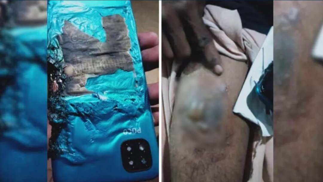 Techkagyan's tweet photo. ⚠️⚠️⚠️⚠️⚠️⚠️⚠️⚠️⚠️⚠️⚠️⚠️
@POCO  Phone User Alert ! The Right leg of the Phone User was Badly #Burned.😥😥😥😥
.
⚡ Click here  https://t.co/jZOAVRANFD
.
#techkagyan #tgarmy #phone #mobile #blast #poco #pocophone #pocophoneblast #POCOC3  #phoneblast #mobileblast #Kerala #burned https://t.co/i3USQwmZ9G