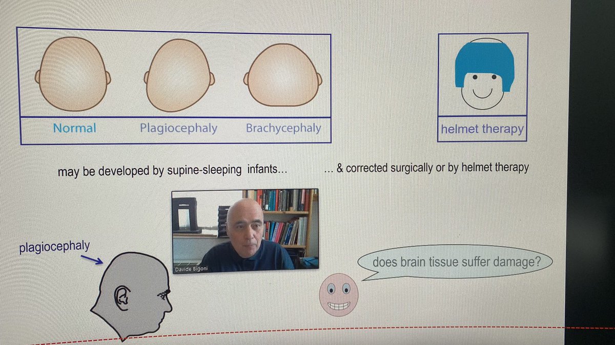 Deformation vs Brain damage: Prof Bigoni from Trento speaks at Liverpool’s LCMH maths-healthcare workshop #lcmhshowcase21