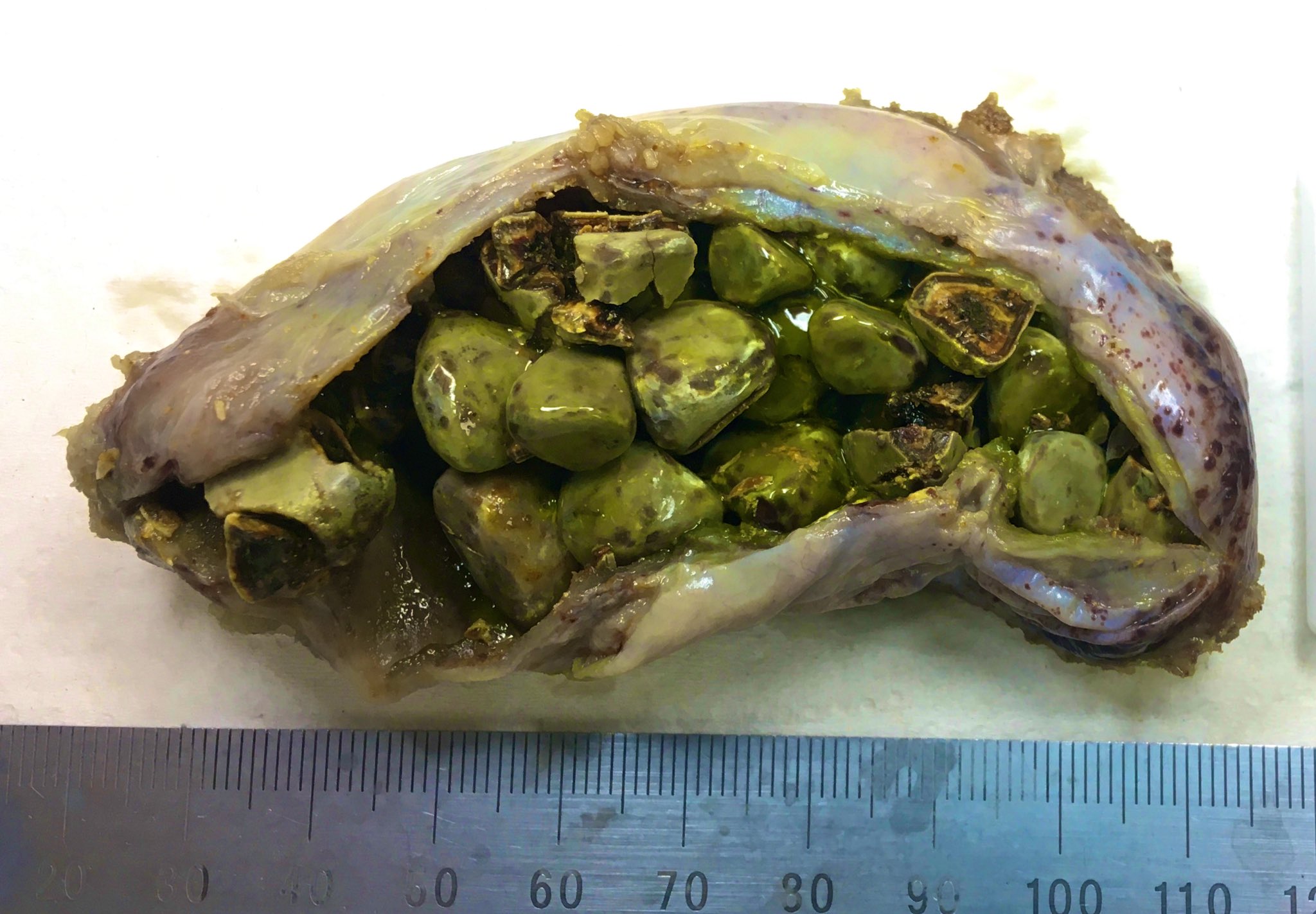 Real gallstones deals