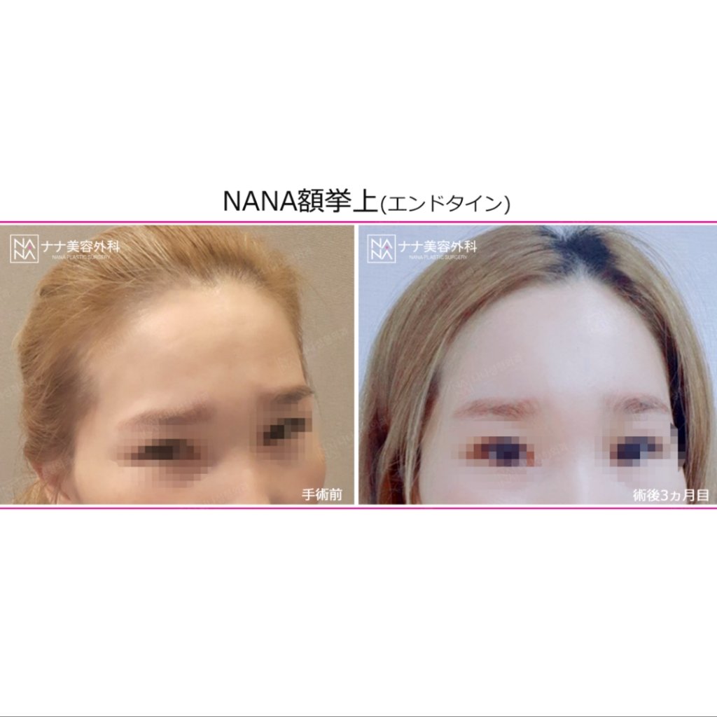 韓国整形nana美容外科 Nanahospital Timeline The Visualized Twitter Analytics