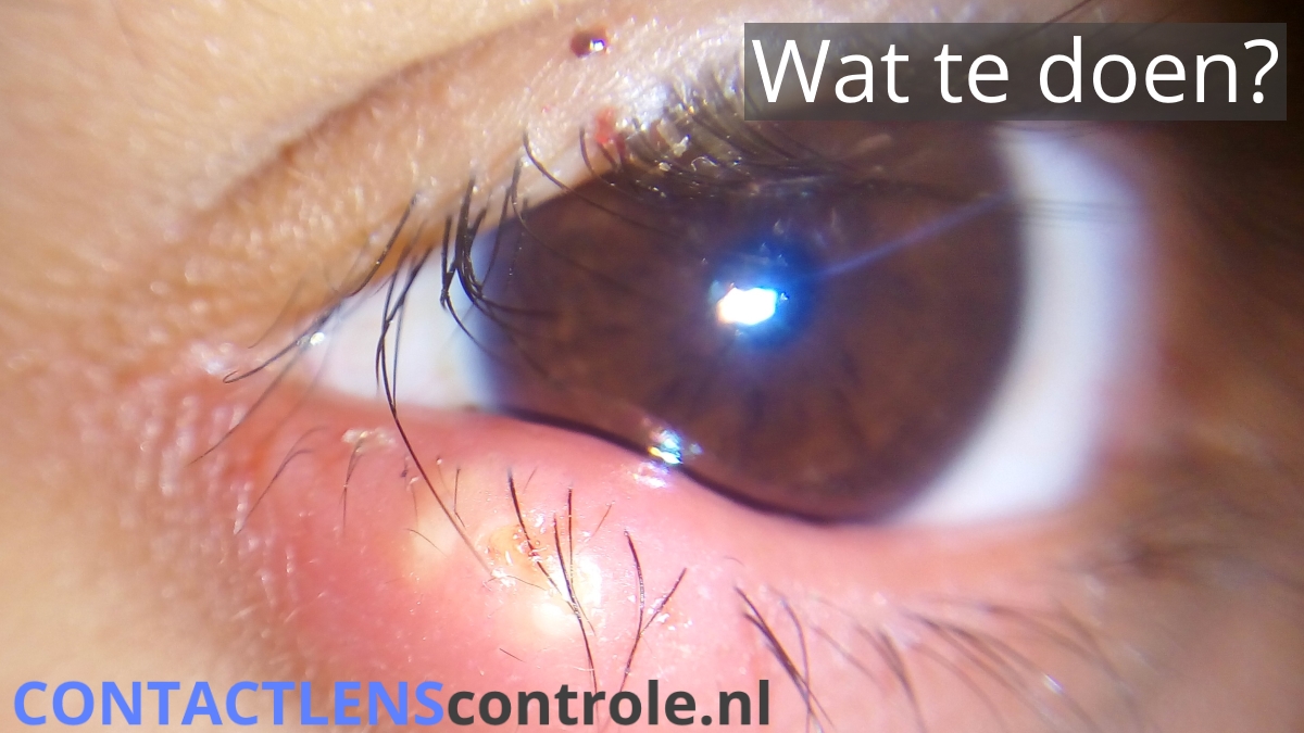Vaak wordt het een strontje op het oog genoemd. In werkelijkheid is het een ontsteking op de rand van het ooglid en komt veel voor. Het kan vervelend en pijnlijk zijn, maar gaat vaak uit zichzelf over. Lees er over op: bit.ly/3gwwFZS 
#strontje
#ogen
#ooglid
#ontsteking