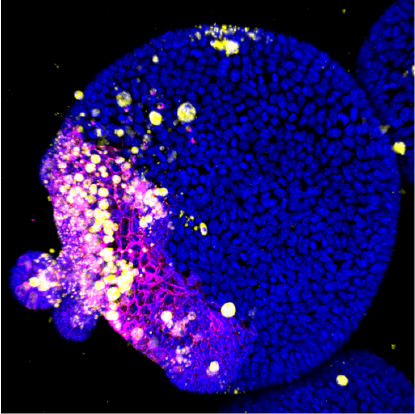 New research by Saskia Suijkerbuijk, Ana Krotenberg Garcia and colleagues shows that intestinal cancer cells use competitive signals to kill surrounding healthy intestinal cells and grow better themselves. ➡️ bit.ly/2UvscR6
