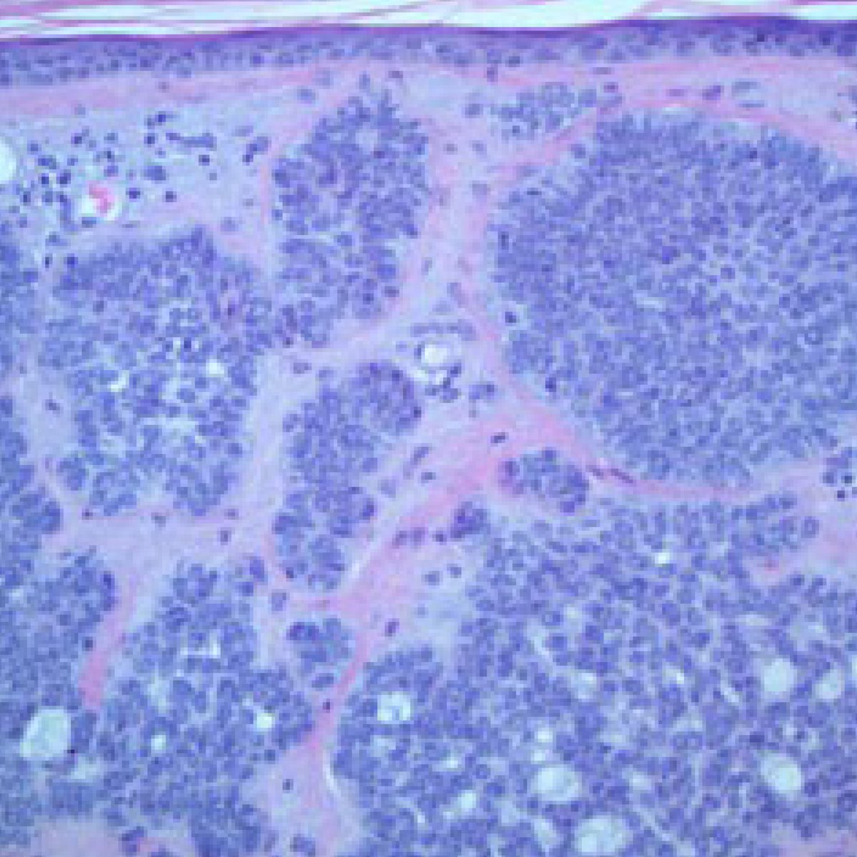 EZDERM's tweet photo. Don’t be fooled! It may look harmless, but skin cancer is a killer. Use EZDERM Path Module to effectively and efficiently diagnosis suspicious skin lesions. https://t.co/sRBEmCYBOy