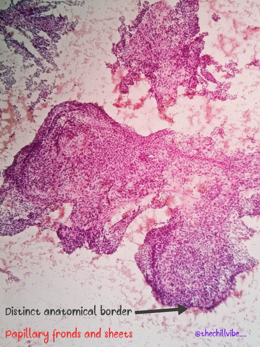 megha_lalcheta's tweet image. Papillary thyroid carcinoma!!!
🎈Most common thyroid cancer
🎈F&amp;gt;M
🎈3rd-5th decade
🎈Good prognosis
🎈Activation of MAPK pathway by point mutations of BRAF or of RAS expression of receptor tyrosine kinase
#FNApath #ENDOpath #pathtwitter