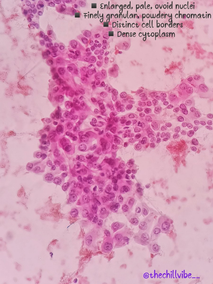 megha_lalcheta's tweet image. Papillary thyroid carcinoma!!!
🎈Most common thyroid cancer
🎈F&amp;gt;M
🎈3rd-5th decade
🎈Good prognosis
🎈Activation of MAPK pathway by point mutations of BRAF or of RAS expression of receptor tyrosine kinase
#FNApath #ENDOpath #pathtwitter