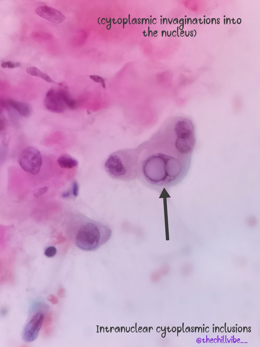 megha_lalcheta's tweet image. Papillary thyroid carcinoma!!!
🎈Most common thyroid cancer
🎈F&amp;gt;M
🎈3rd-5th decade
🎈Good prognosis
🎈Activation of MAPK pathway by point mutations of BRAF or of RAS expression of receptor tyrosine kinase
#FNApath #ENDOpath #pathtwitter