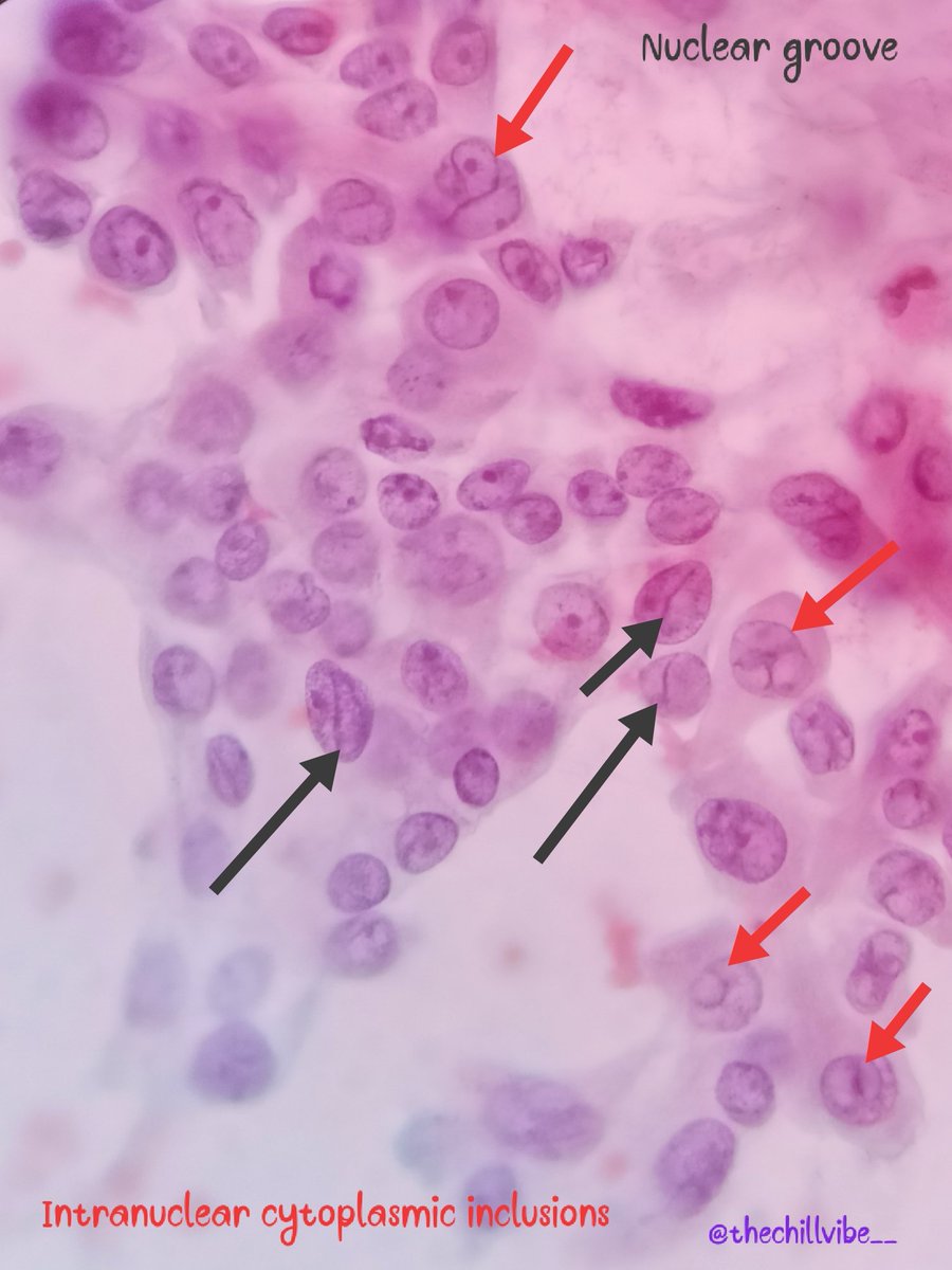 megha_lalcheta's tweet image. Papillary thyroid carcinoma!!!
🎈Most common thyroid cancer
🎈F&amp;gt;M
🎈3rd-5th decade
🎈Good prognosis
🎈Activation of MAPK pathway by point mutations of BRAF or of RAS expression of receptor tyrosine kinase
#FNApath #ENDOpath #pathtwitter