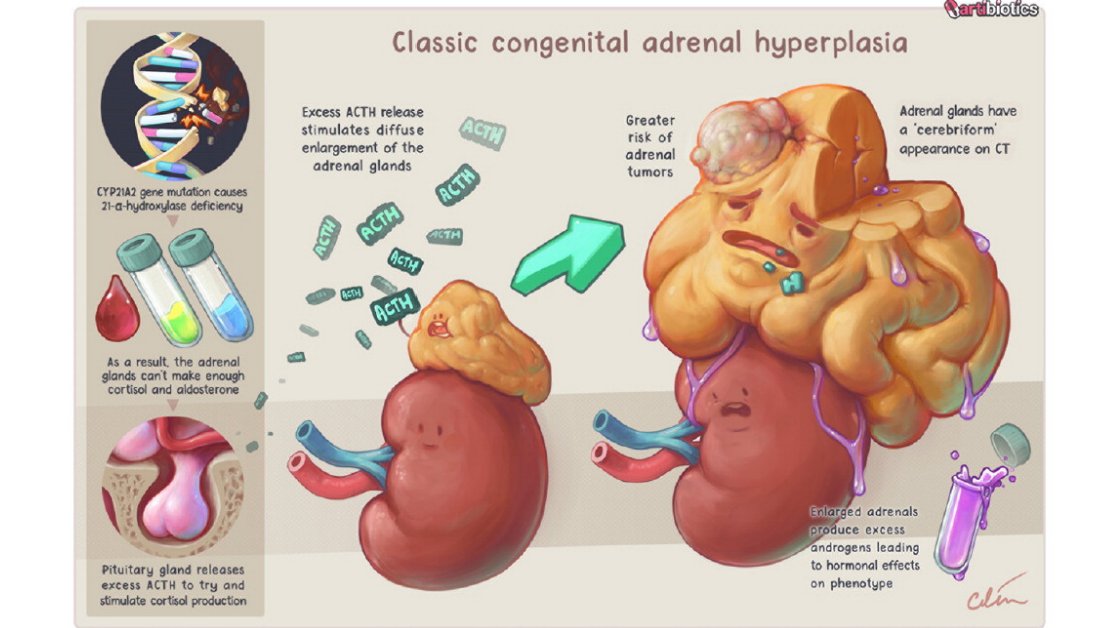 RadioGraphics (@radiographics) on Twitter photo This issue's <a href="/CasesCookyJar/">Cases From the Cooky Jar</a> describes congenital adrenal hyperplasia, which can increase patients' risk for adrenal abnormalities such as myelolipoma, benign adenoma, hyperplasia, and rarely, pheochromocytoma. <a href="/RadG_Editor/">RadioGraphics_Editor</a> <a href="/cookyscan1/">Cooky Menias</a> @alexnaomimurphy This issue's <a href="/CasesCookyJar/">Cases From the Cooky Jar</a> describes congenital adrenal hyperplasia, which can increase patients' risk for adrenal abnormalities such as myelolipoma, benign adenoma, hyperplasia, and rarely, pheochromocytoma. <a href="/RadG_Editor/">RadioGraphics_Editor</a> <a href="/cookyscan1/">Cooky Menias</a> @alexnaomimurphy