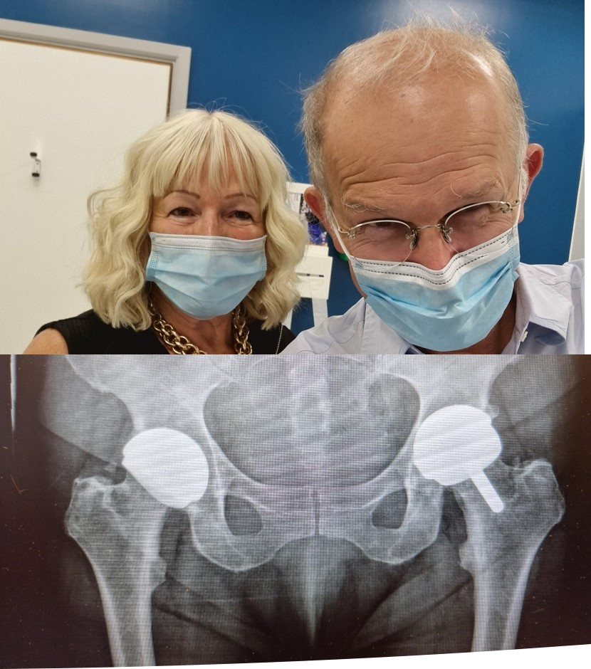 Justin Cobb (@orthorobodoc) on Twitter photo female athlete functioning far beyond Oxford Hip Score 3yrs after a ceramic H1 from <a href="/embodyortho/">Embody</a>, <a href="/MSkLab1/">MSk Lab</a> <a href="/ceramtec/">Amireshonam Ceram teck</a> @Medicoate and <a href="/ImperialNHS/">Imperial NHS 💙</a> and 15 yrs after a metal Birmingham Hip from <a href="/ProfMiddleton/">Professor Robert Middleton</a> #orthotwitter #hipresurfacing #hipreplacement female athlete functioning far beyond Oxford Hip Score 3yrs after a ceramic H1 from <a href="/embodyortho/">Embody</a>, <a href="/MSkLab1/">MSk Lab</a> <a href="/ceramtec/">Amireshonam Ceram teck</a> @Medicoate and <a href="/ImperialNHS/">Imperial NHS 💙</a> and 15 yrs after a metal Birmingham Hip from <a href="/ProfMiddleton/">Professor Robert Middleton</a> #orthotwitter #hipresurfacing #hipreplacement