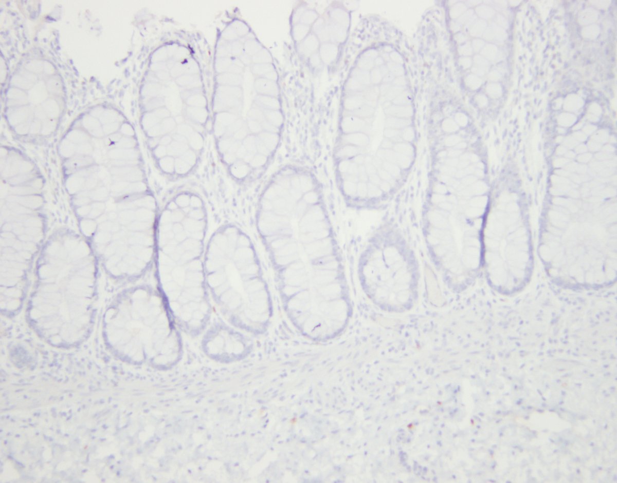 stephen_lagana's tweet photo. For the pathology trainees- calretinin IHC is great for dxing Hirschsprung's dz. Pics from same case, the distal aganglionic segment is dead neg for calretinin. The proximal normal segment shows cal positivity in ganglion cells, and also in mucosal nerve twigs.#gipath #pathology https://t.co/txrVfyHtaT