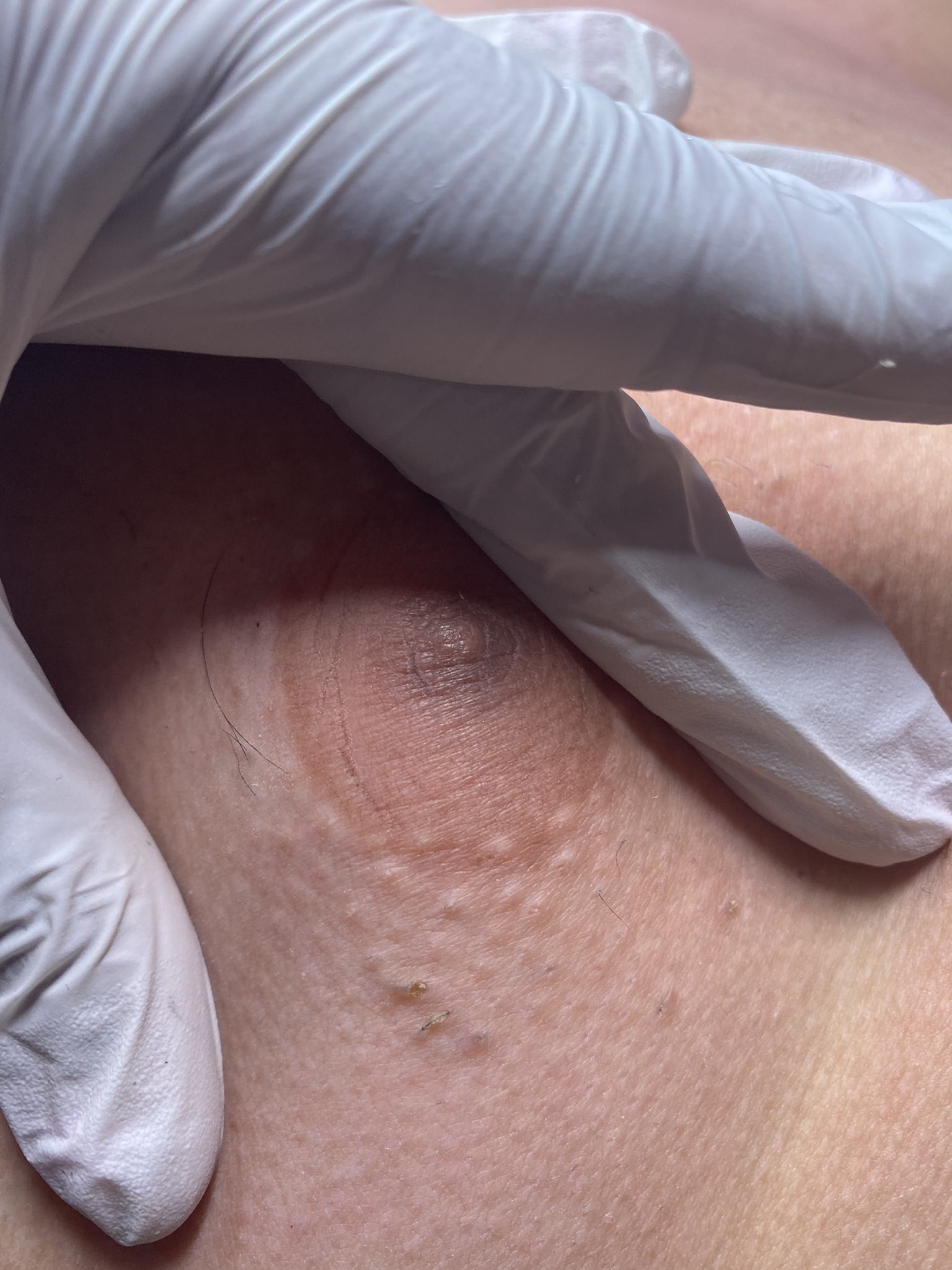 Ingrown nipple hair deals