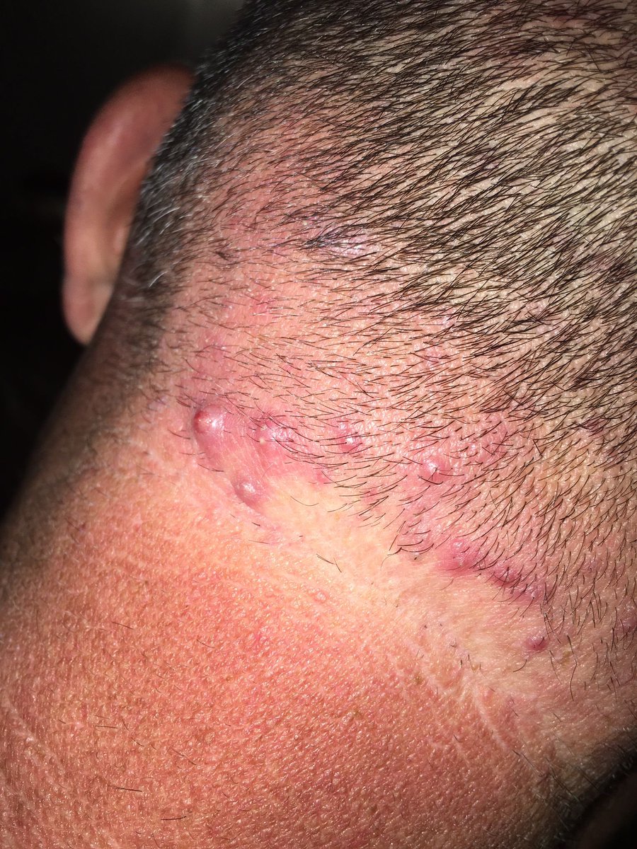 julianconejomir's tweet photo. Elastoidosis perforans serpiginosa en el cuello. Eliminación por la piel de fibras elásticas. Dermatosis perforante. @DermaHUVRocio #dermatologia https://t.co/MMFTG5sZM6