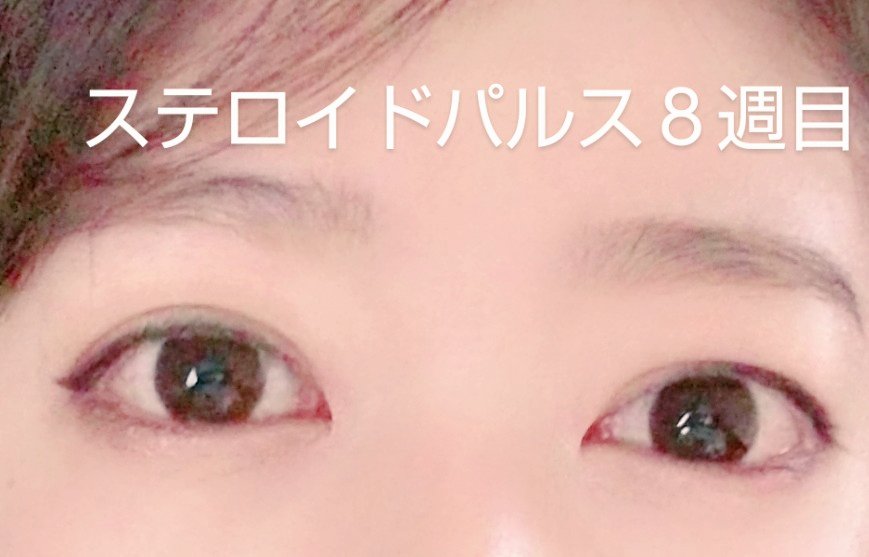 ট ইট র おたぬちゃん パルス終了後３ヶ月目の検査で 突出は左16右16 8 9と僅かに良くなっていました ２ヶ月目の時点で右目の奥に残っていた炎症も大人しくなってくれた様で安心しました 突出の方はこの辺が限界かな でも悪くなってない事が大事