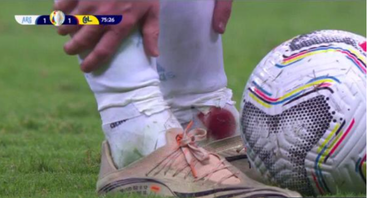 gianoddi's tweet photo. Essa imagem do tornozelo de Messi impressiona. Pelo sangue, claro, mas também pelas reações do jogador após sofrer a entrada que causou o ferimento. A impressão que dá é que sua ânsia por jogar futebol o impede de perder tempo com valorizações, simulações e reclamações. Exemplar. https://t.co/EVzr6a4Jmy