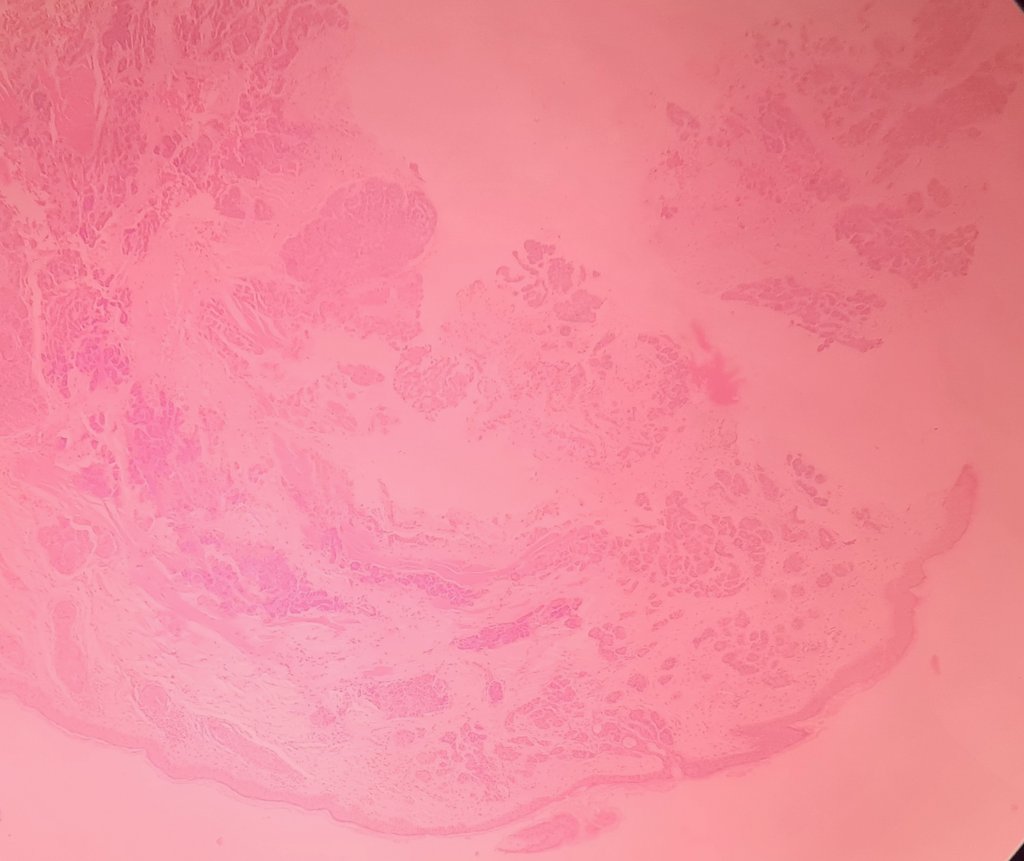 juanbarcia's tweet photo. @MarcelaSaebL @pbaleixo @JMGardnerMD @pepeheffernan @pembeoltulu F/50yo eyelid "cyst". Quick shots. Adnexal to me....which name? https://t.co/j45WpW6MMp